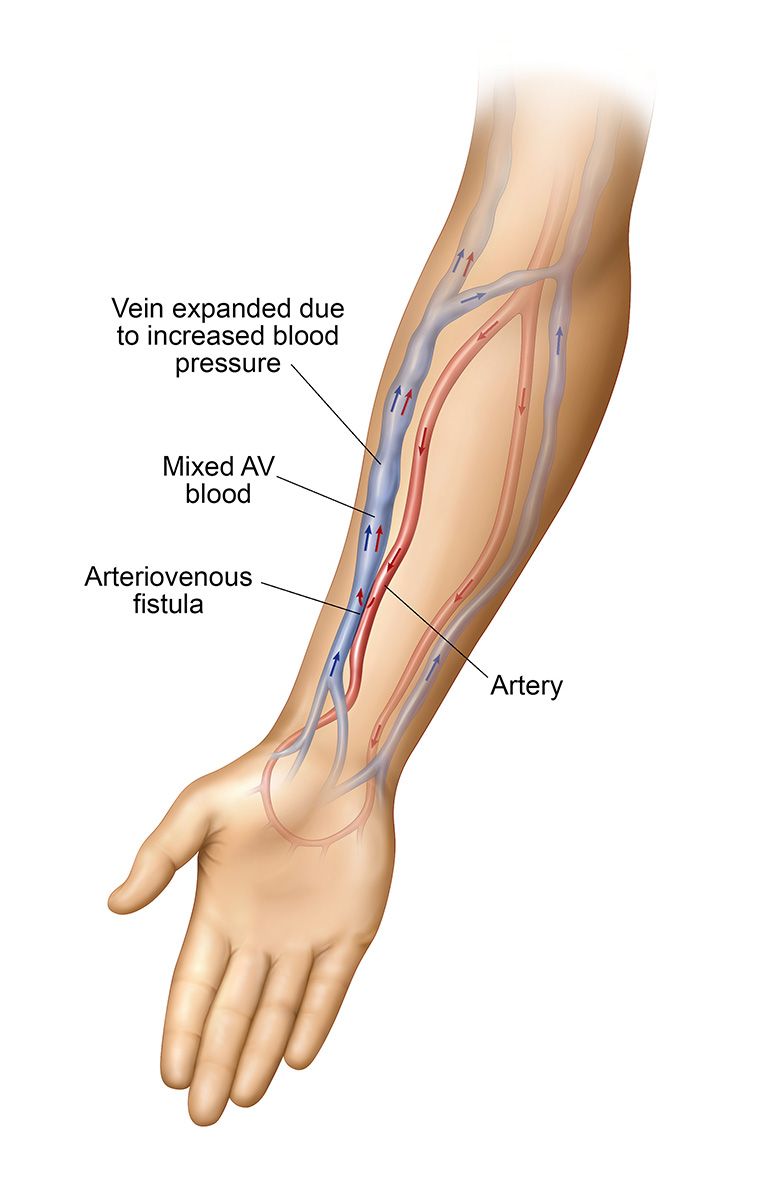 AV-fistula-1